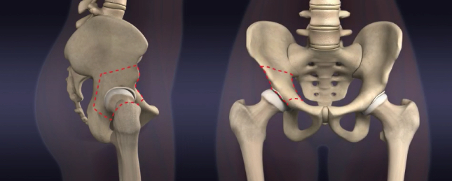 Osteotomias pélvicas e femorais: O que são, indicações e resultados