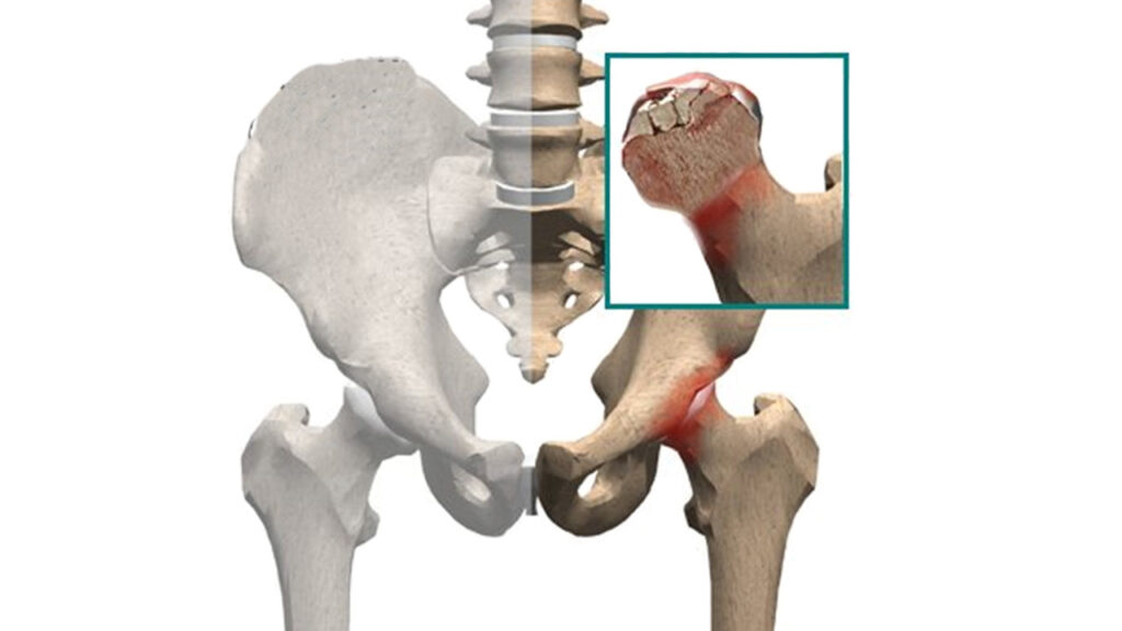 Imagem que representa necrose avascular da cabeça femoral