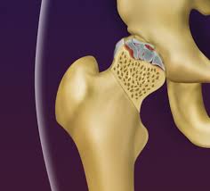 Osteonecrose da cabeça de fêmur