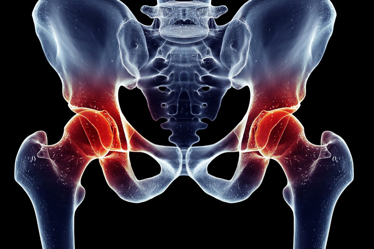 Osteoartrite no quadril. Dr. Fellipe Takatsu Ortopedista