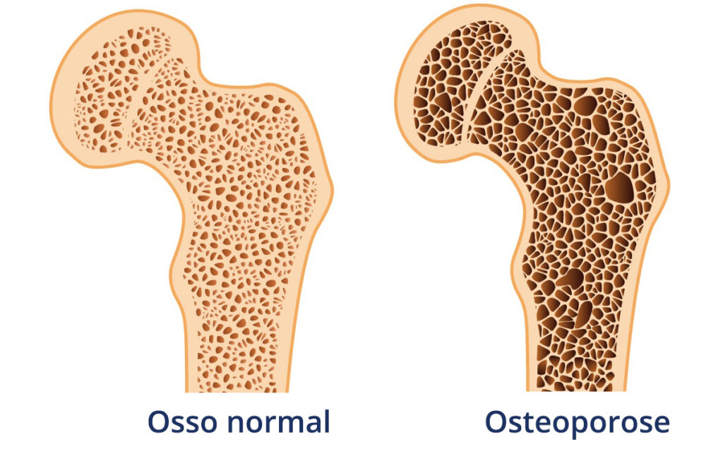 Imagem que mostra a Diferença de osso normal com osso com osteoporose