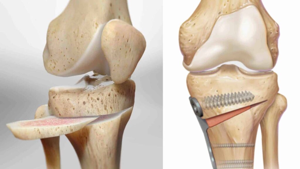 imagem representando Osteotomia Femoral no joelho