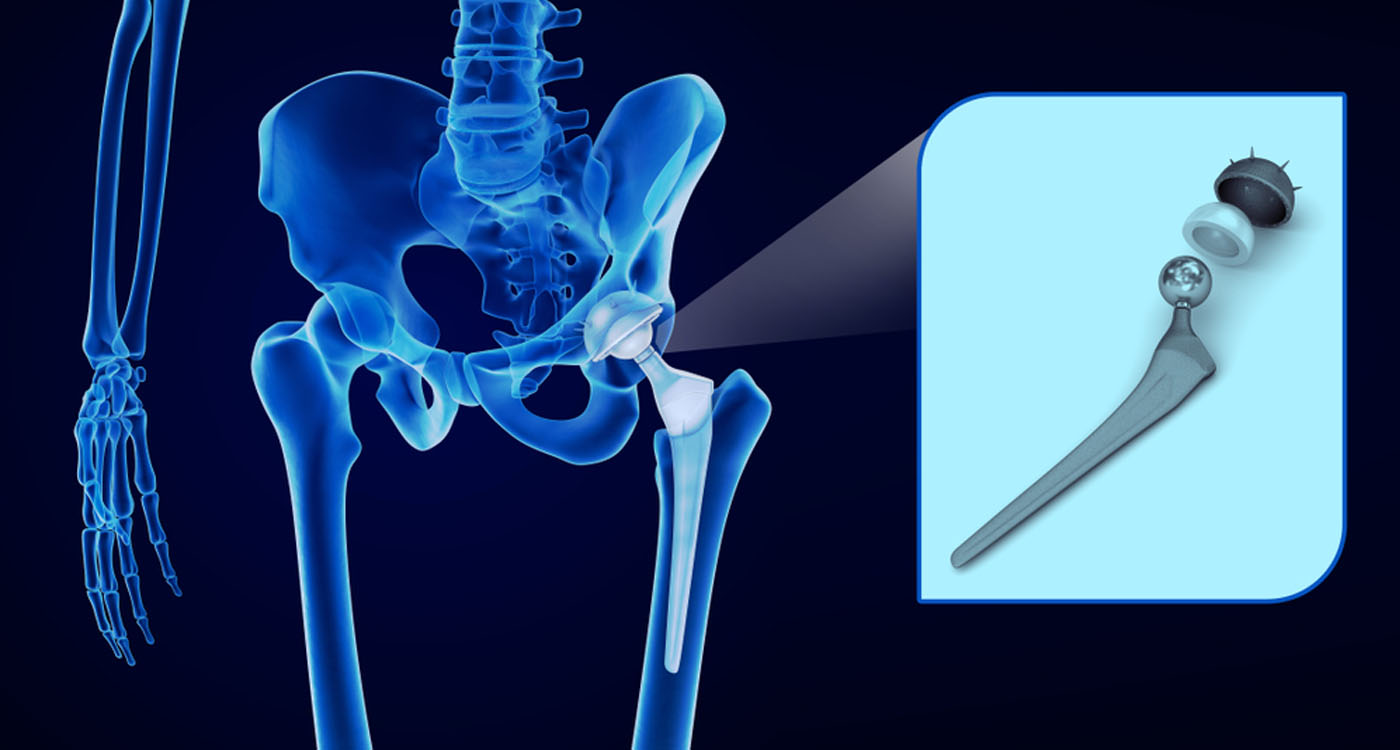 Artroplastia total de quadril (ATQ) ou Prótese de quadril. Entenda quando esse procedimento é indicado!